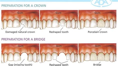 dental bridges rosebud